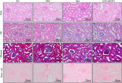 Metformin Improves the Senescence of Renal Tubular Epithelial Cells in a High-Glucose State Through E2F1